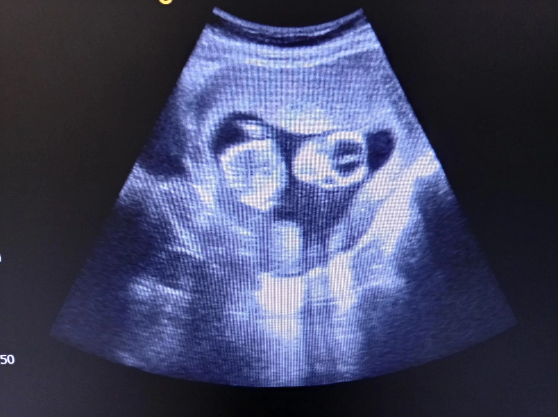 13 weeks ultrasound