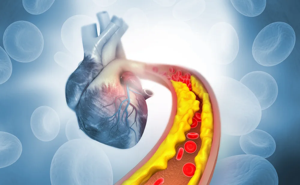 How-to-Reduce-Plaque-in-Arteries