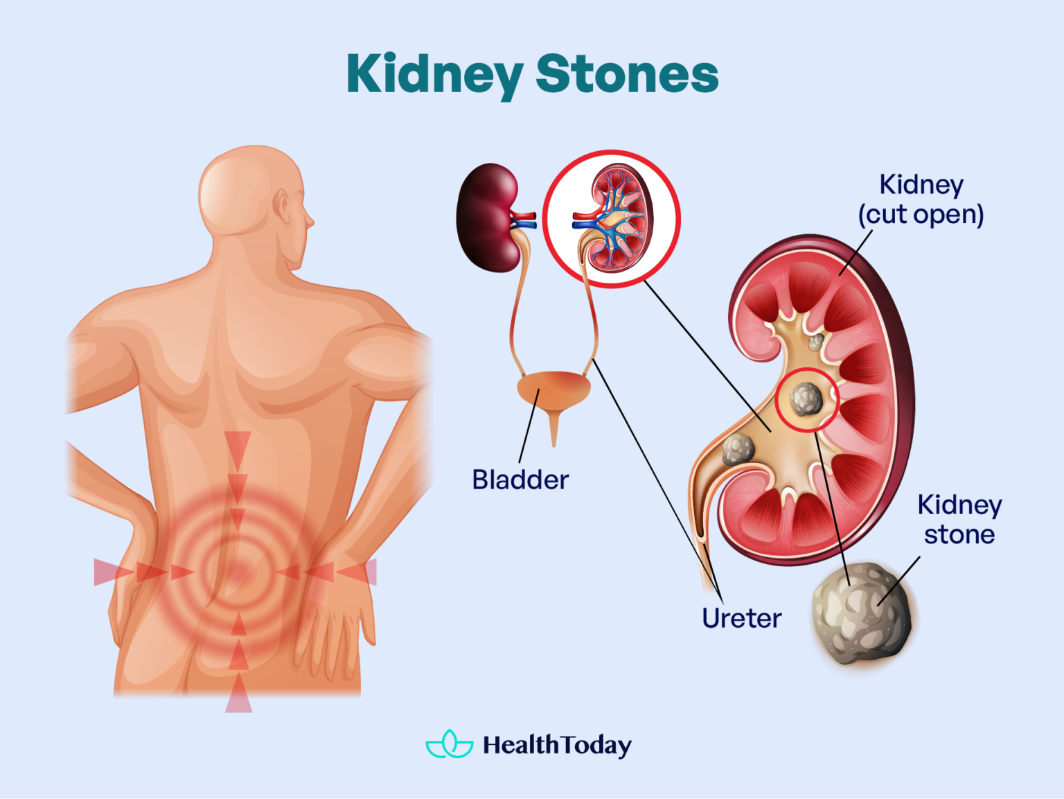 do-kidney-stones-cause-back-pain-signs-to-tell-healthtoday