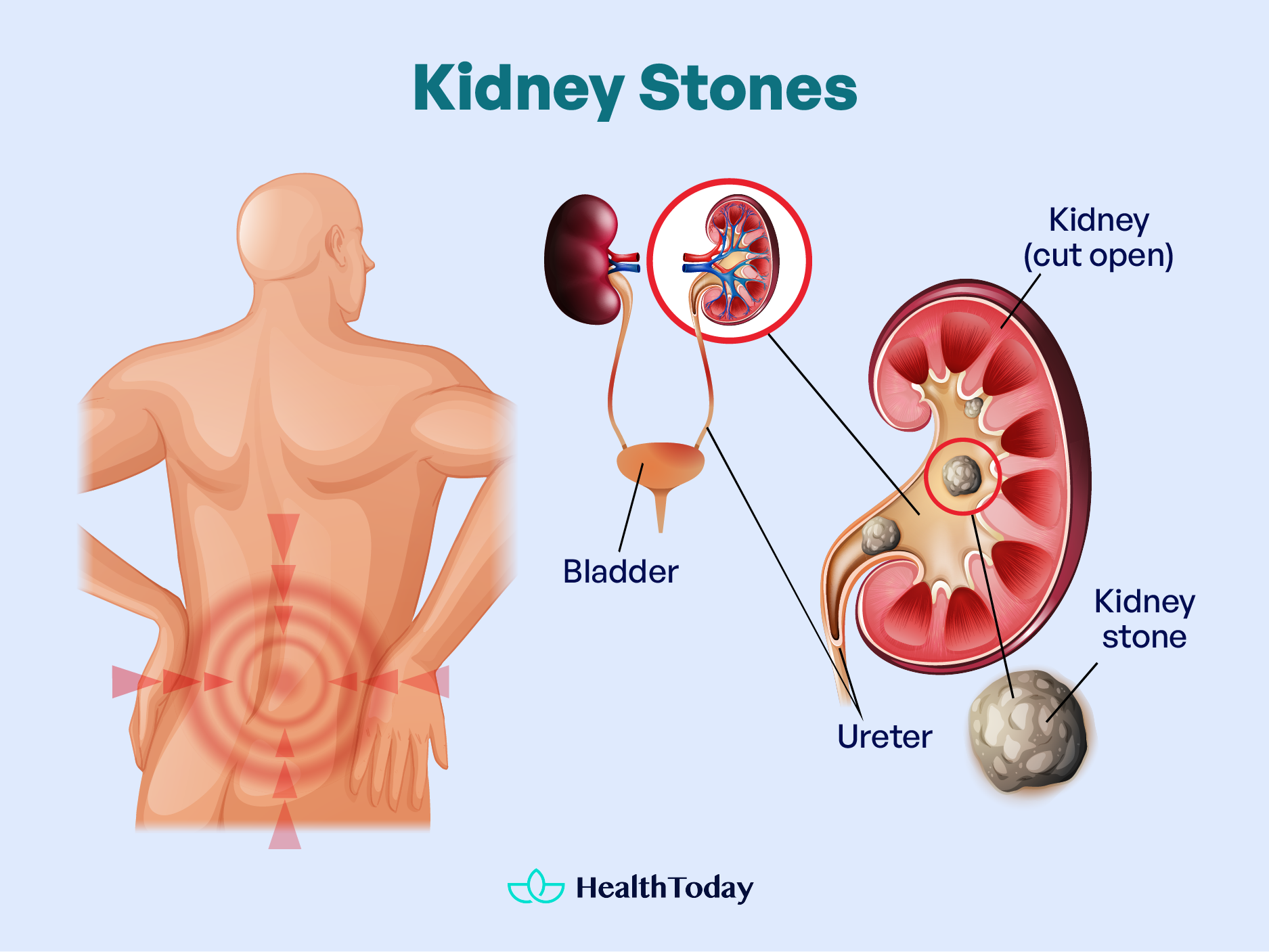 Do Kidney Stones Cause Back Pain Signs To Tell 01