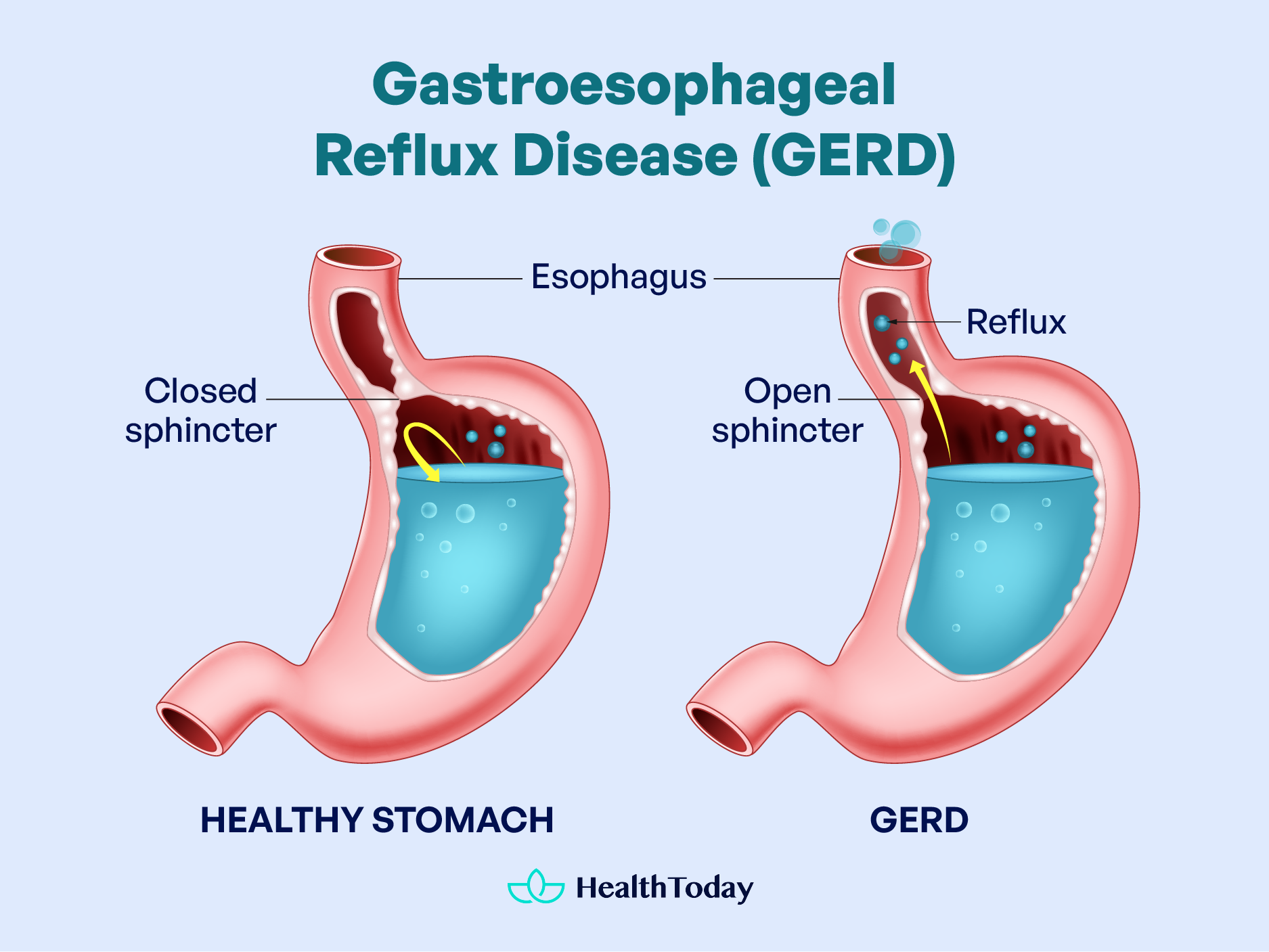 GERD Symptoms at Night How to Sleep With GERD 01