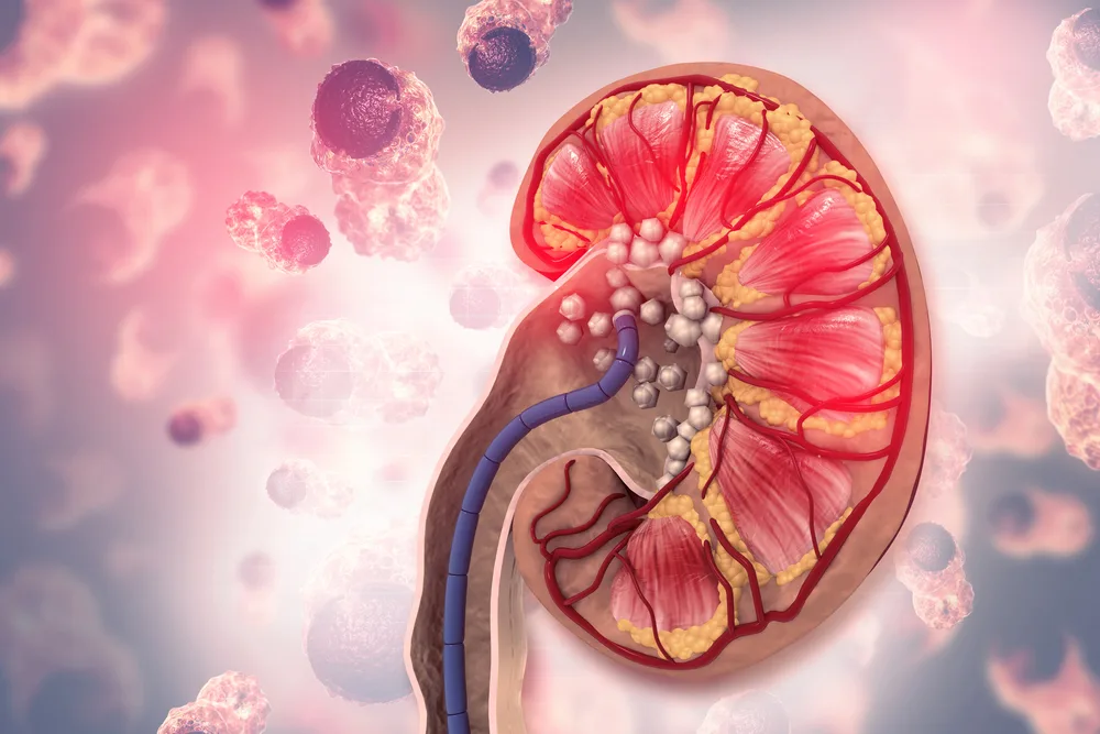 Medical illustration of kidney stones