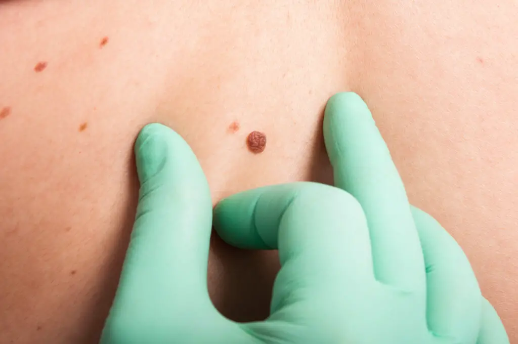 You Can Die From Skin Cancer But It Isn't Always Fatal