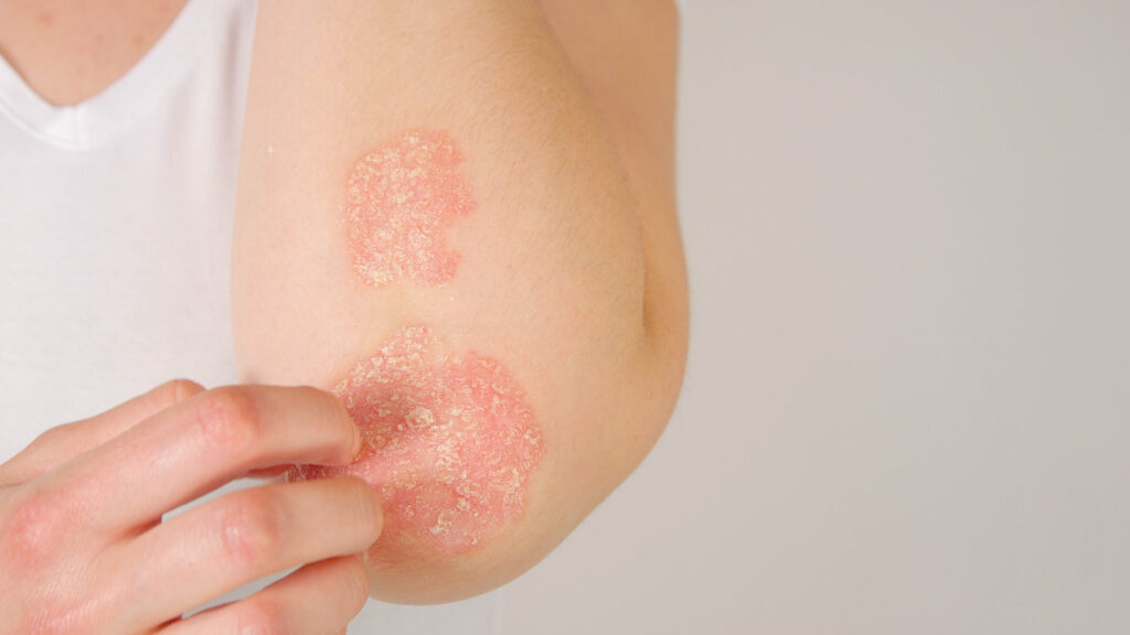 10 Illnesses and Chronic Diseases Caused By Stress